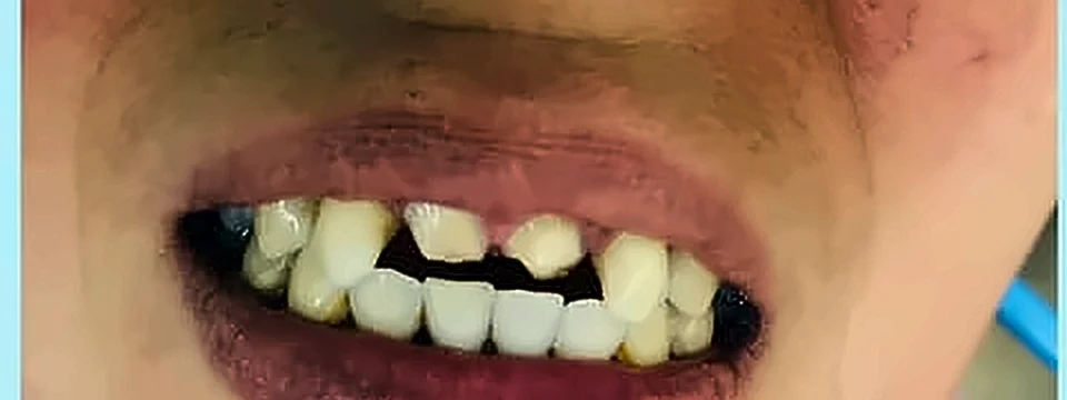 Antes: dientes anteriores faltantes y desalineados