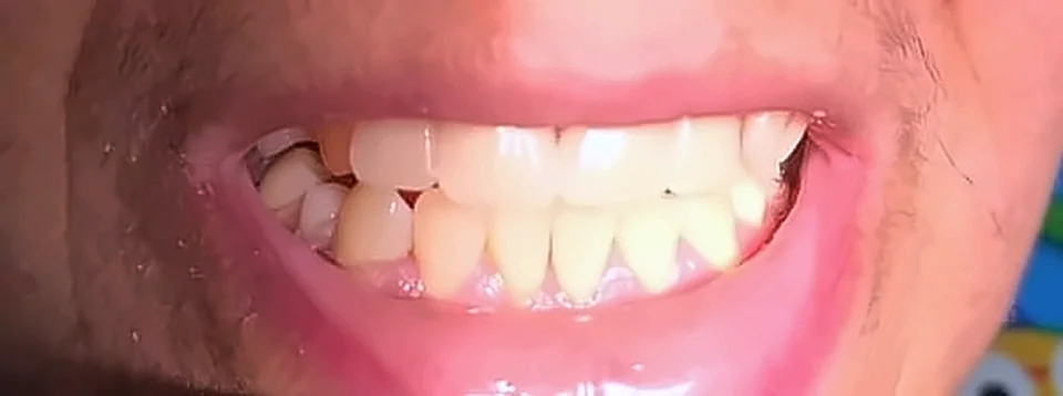 Después: dientes superiores completos