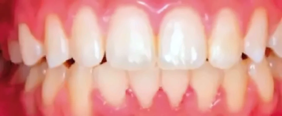 Después: dientes alineados al terminar el tratamiento
