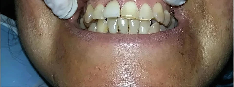 Antes: dientes con desgaste y color amarillento