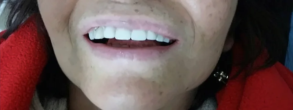 Después: sonrisa completa con prótesis