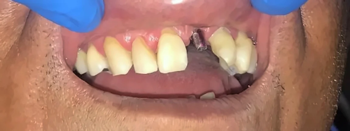 Antes: falta un diente anterior superior