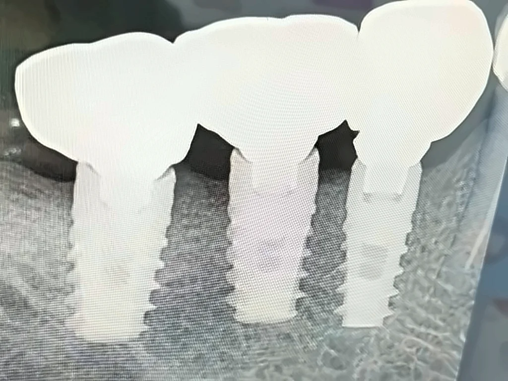 Radiografía de tres implantes dentales con sus coronas
